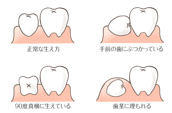 親知らず 抜く 抜かない 抜いたら小顔になる 札幌歯科 札幌の世界標準のインプラント歯医者